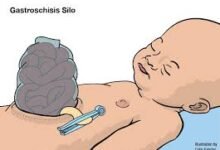 Gastroschisis