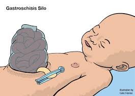 Gastroschisis